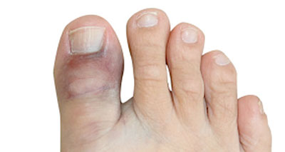 Broken toe