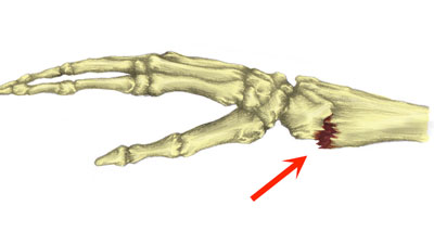 Colles fracture