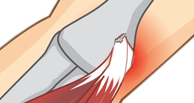 Elbow avulsion