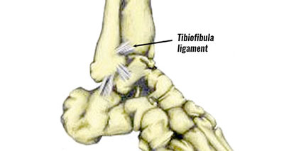 High ankle sprain