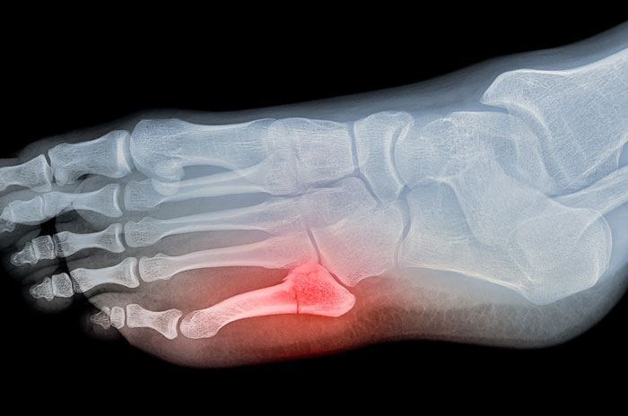 Jones fracture x-ray