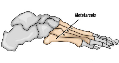 Metatarsalgia