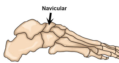 Navicular bone top of foot pain