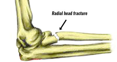 Radial head fracture