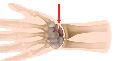 Scaphoid