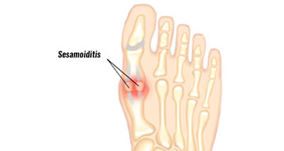 Sesamoiditis