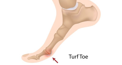 Turf toe