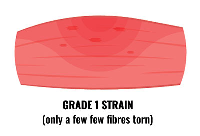 Grade 1 muscle strain