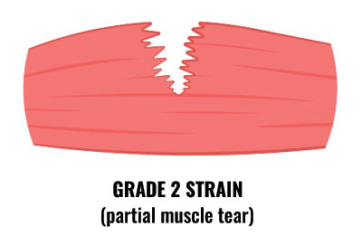 Grade 2 muscle strain