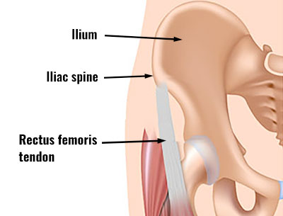 Rectus femoris tear anatomy