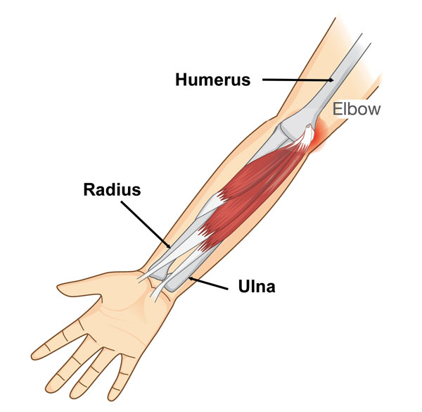 Elbow avulsion strain