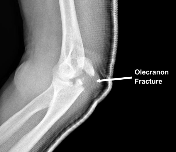 Olecranon fracture X ray