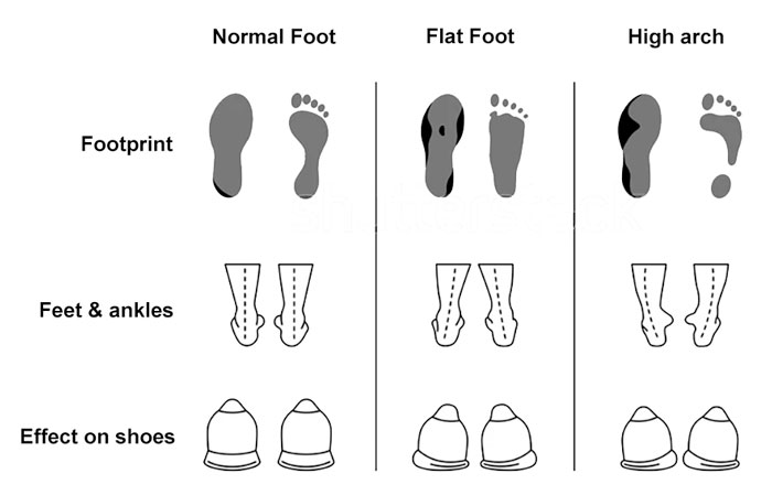 Oversupination and effect on shoes