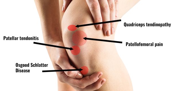 Anterior knee pain at the front of the knee