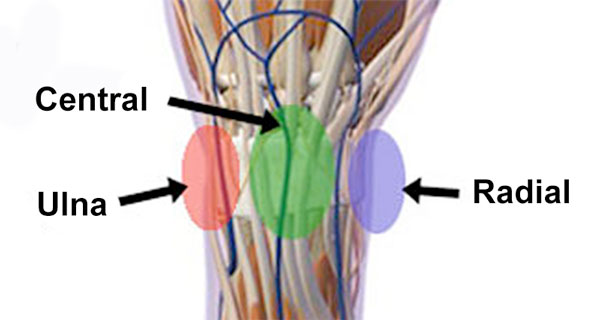 Dorsal wrist pain