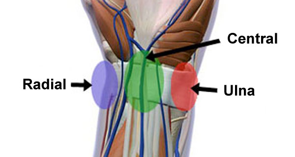 Volar wrist pain