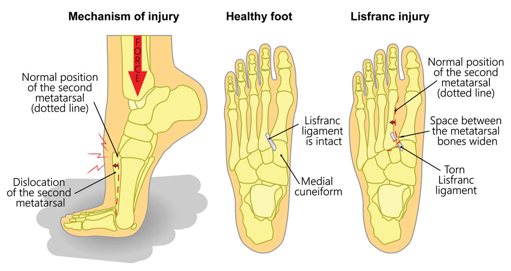 Lisfranc injury explained
