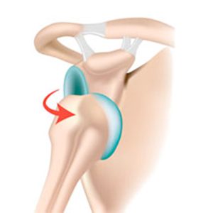 anterior shoulder dislocation