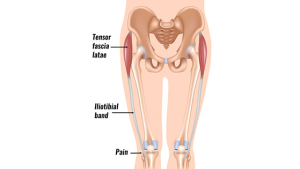 Ober's Test - Sportsinjuryclinic.net