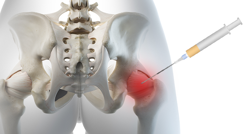 Hyaluronic Acid Injections For Hip Pain
