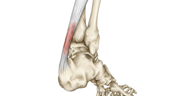 Achilles tendonitis