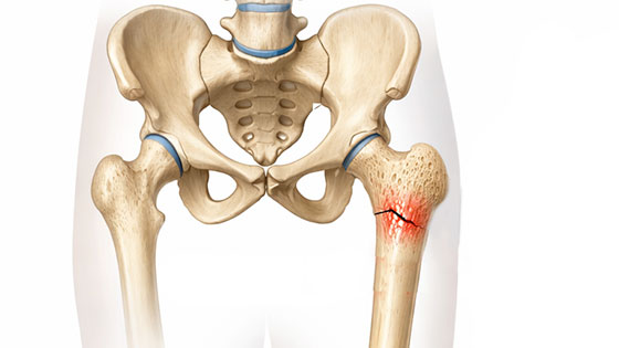 femur stress fracture
