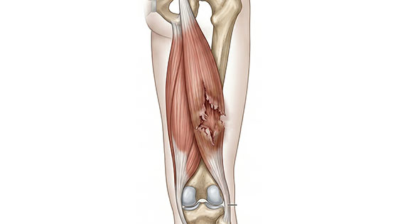 hamstring strain