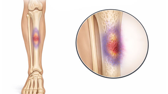 periosteal contusion shin