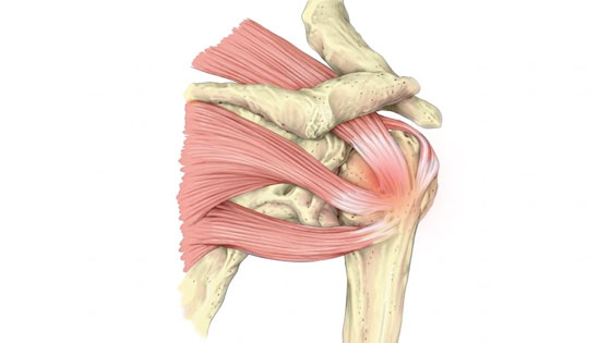 rotator cuff strain