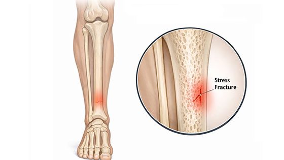 tibia stress fracture