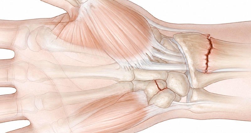 wrist fractures